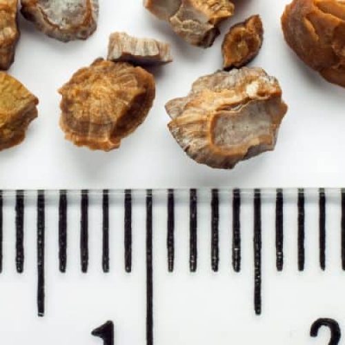 Come risolvere i problemi di calcoli renali