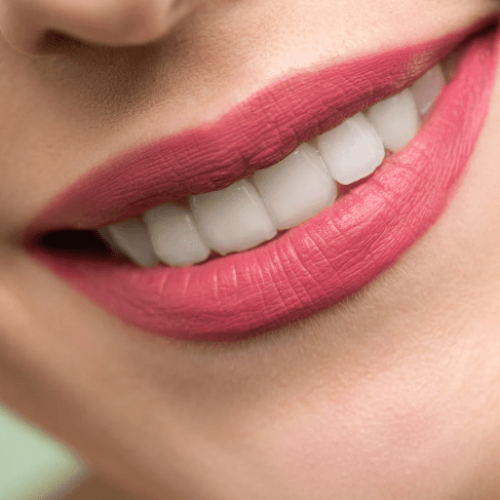 Applicazione di faccette dentali Marano di Napoli