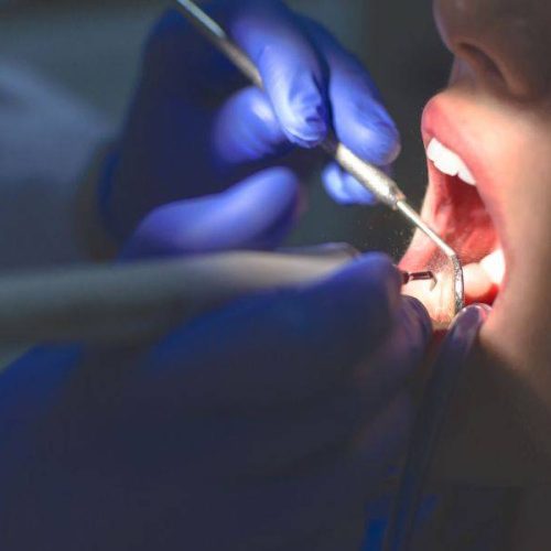 Impianto dentale a rate Palermo