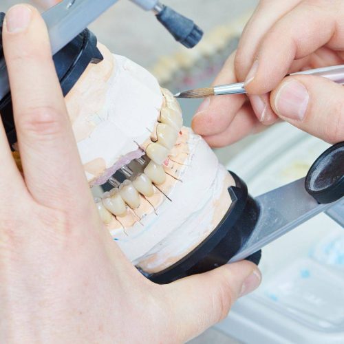 Protesi Dentaria in Provincia di Chieti: Soluzioni per un Sorriso Completo e Funzionale