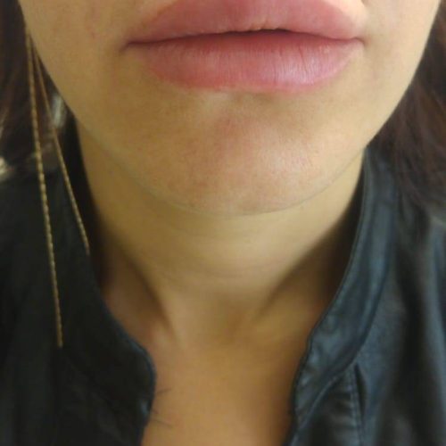 Filler Corigliano Calabro
