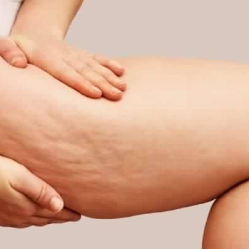 Trattamento delle rughe con botulino a Cosenza